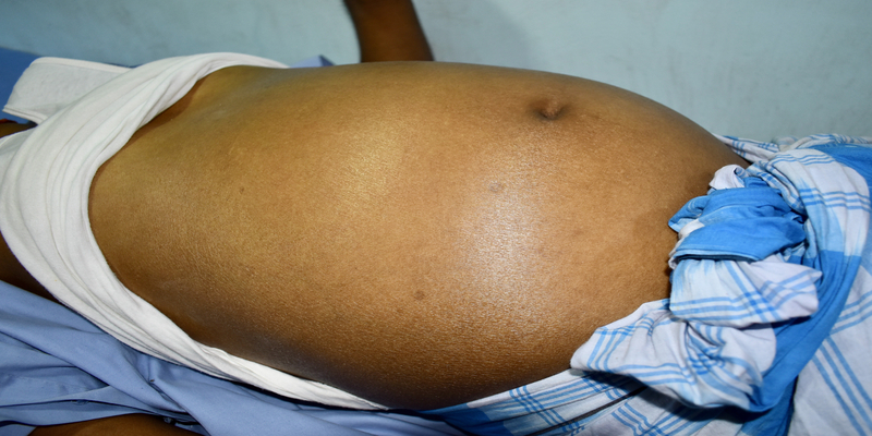Sangramento digestivo variceal: as condutas na emergência 