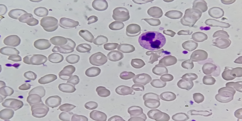 Abordagem diagnóstica da anemia hemolítica 