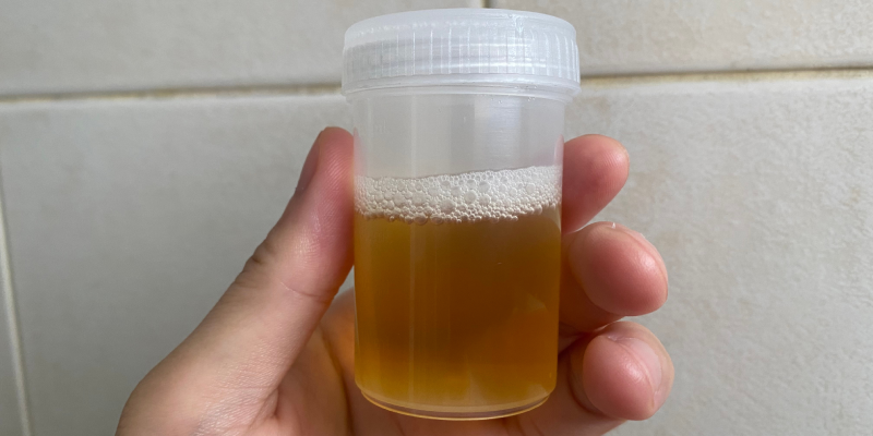 Proteinúria: definições e abordagem diagnóstica