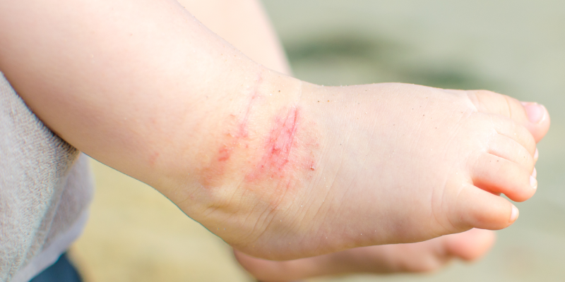 Dermatite atópica em criança: quadro clínico e tratamento 