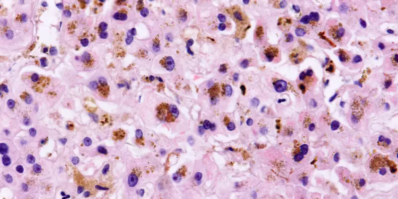 Hemocromatose diagnóstico e manejo