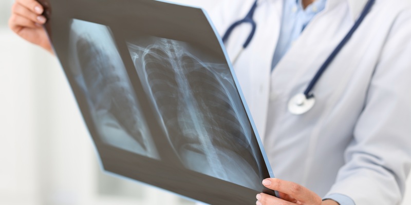 Nódulo pulmonar: como investigar?