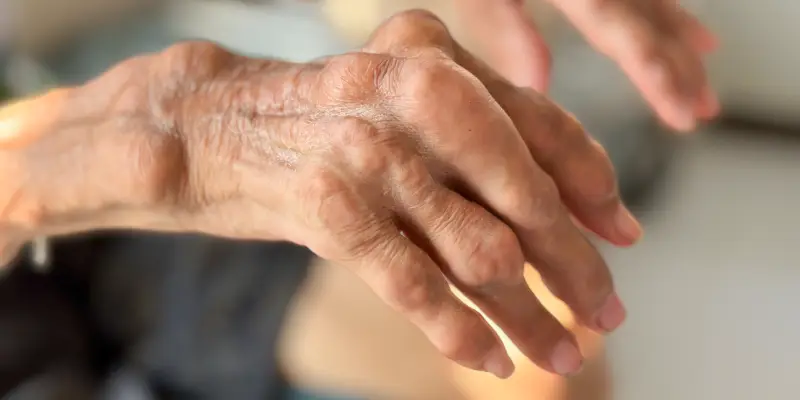 Abordagens da fisioterapia para artrite reumatoide