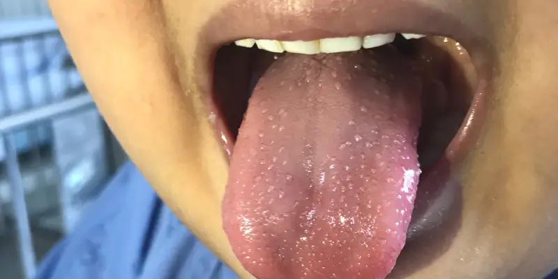 Doença de Kawasaki: diagnóstico, critérios clínicos e manejo em pediatria 