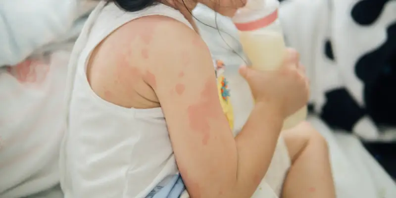 Alergia alimentar em Pediatria
