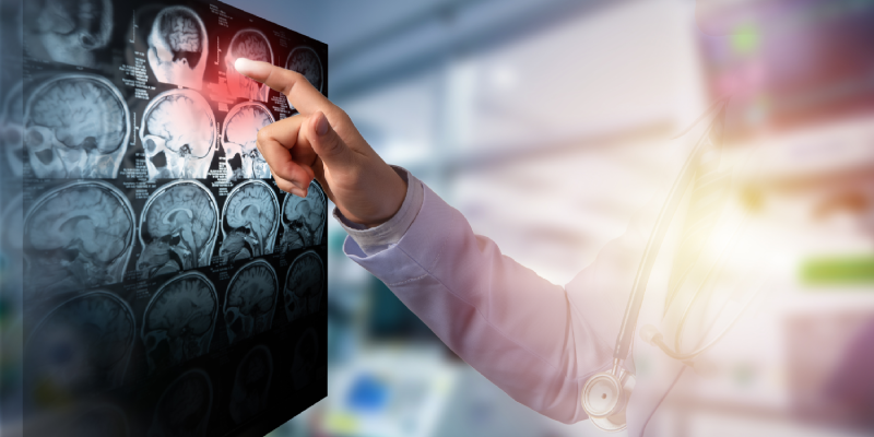 AVC em pacientes jovens: como investigar?